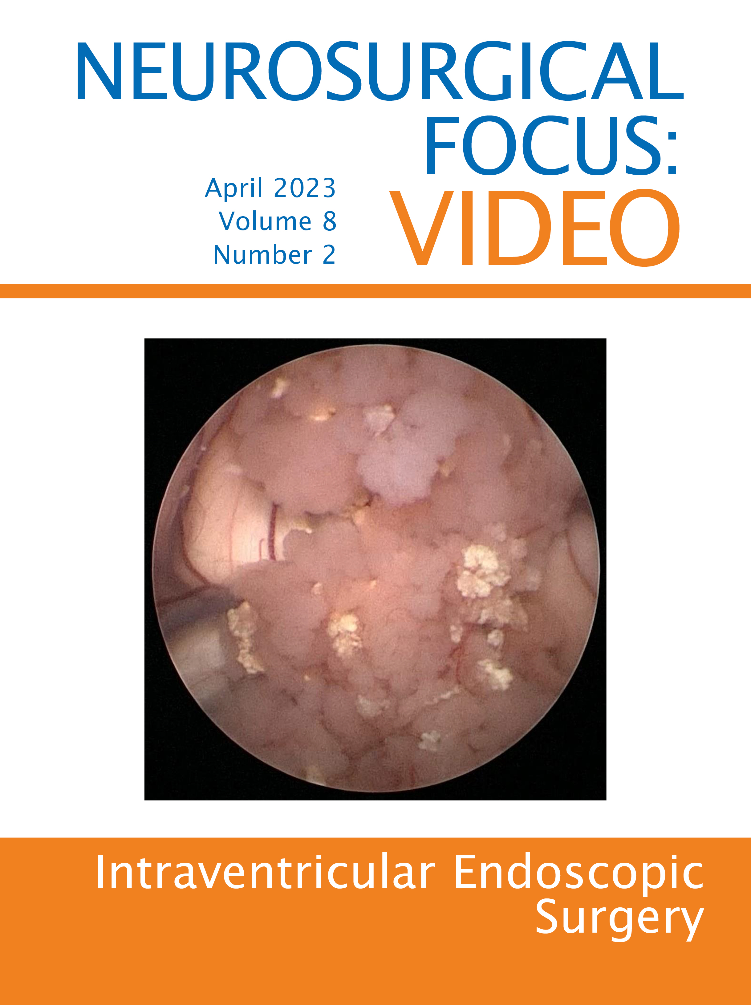 第8卷:第2期(2023年4月):脑室内窥镜手术